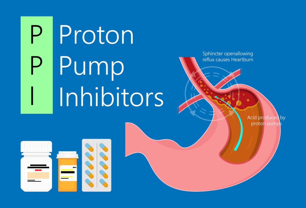 Proton Pump Inhibitors (PPIs): Long-Term Relief From Acid Reflux