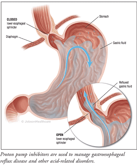 Proton Pump Inhibitors (PPIs): Long-Term Relief From Acid Reflux