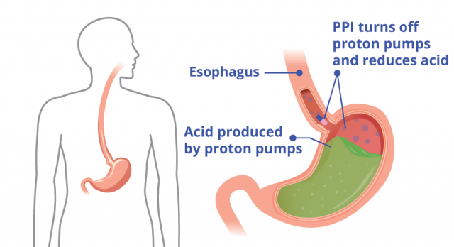 Proton Pump Inhibitors (PPIs): Long-Term Relief From Acid Reflux