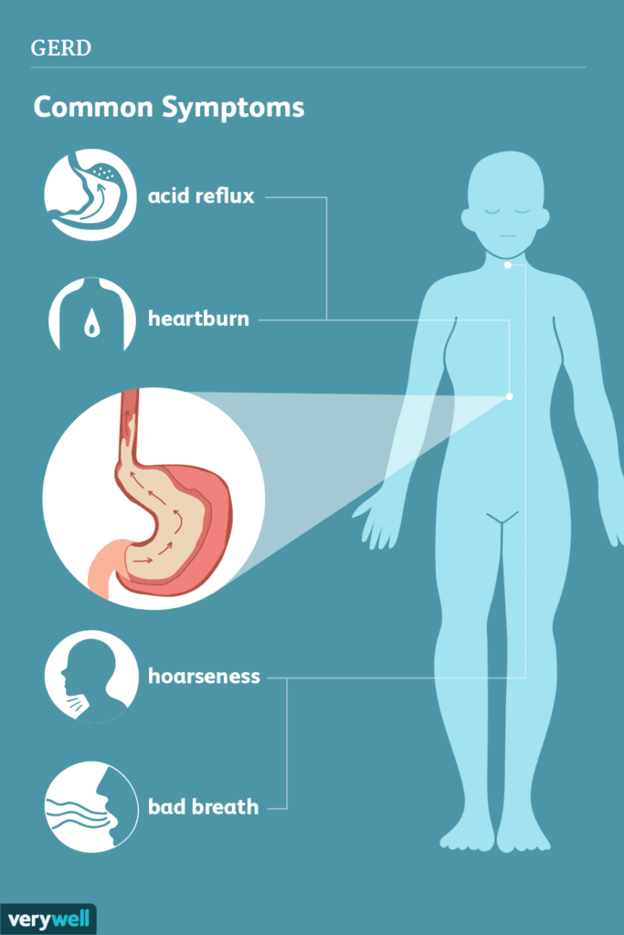 When To See A Doctor For Acid Reflux: Warning Signs To Watch For